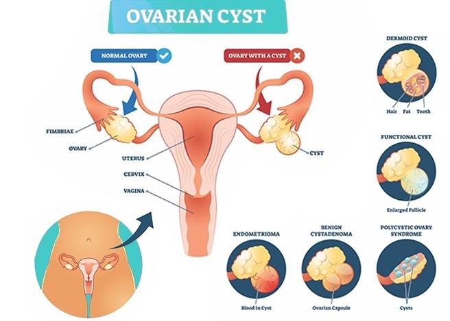 Types of Ovarian Cysts: Symptoms, Causes, and Treatment Options
