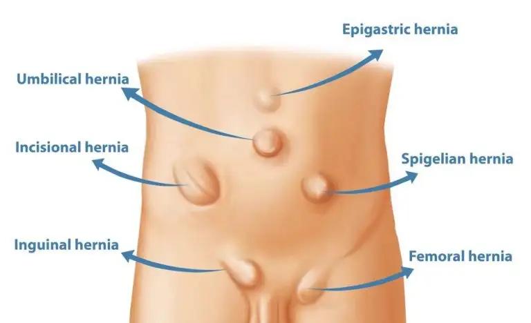 Causes of Hernia