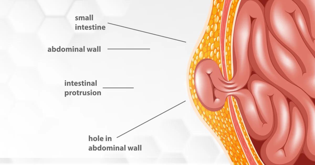Symptoms of a Hernia