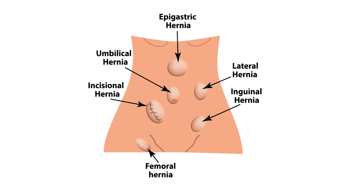 Treatment of Hernia