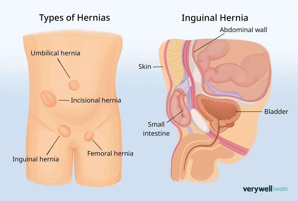 Types of Hernia