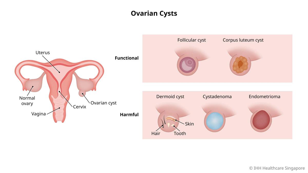 Causes of Ovarian Cysts
