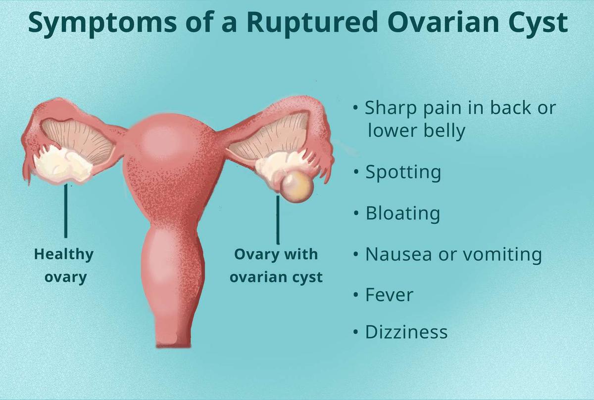 Symptoms of Ovarian Cysts