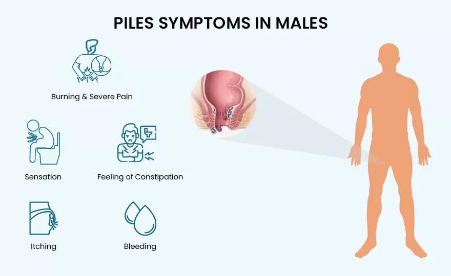 Symptoms of Piles