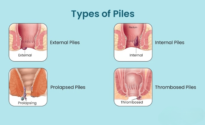 Types of Piles