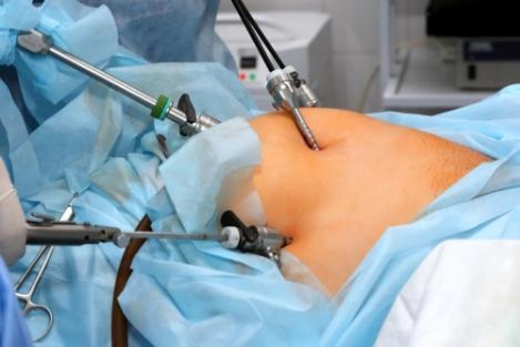 What Is Advanced Laparoscopic Surgery? Benefits, Procedure &amp; Recovery Explained
