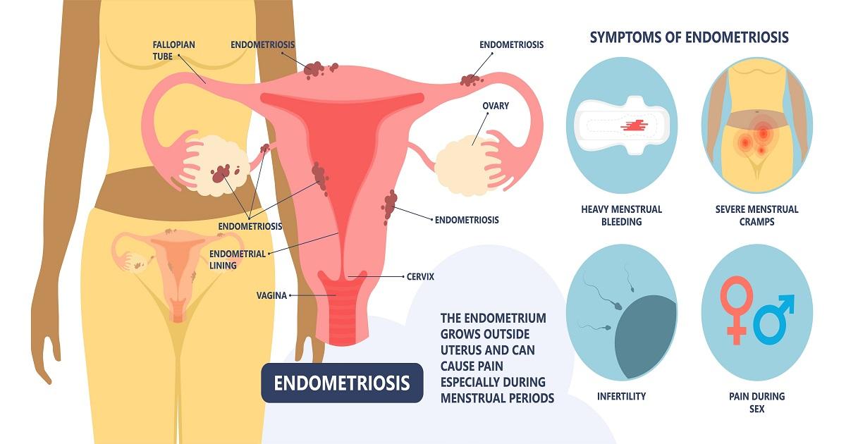 Causes of Endometriosis