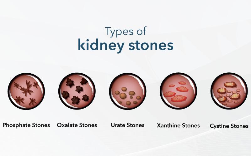 Types of Kidney Stones