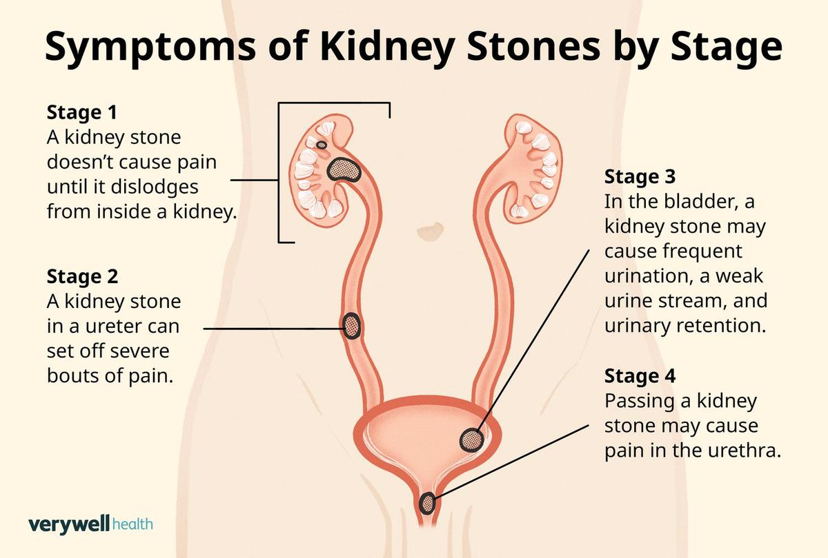 Symptoms of Kidney & Gall Bladder Stones