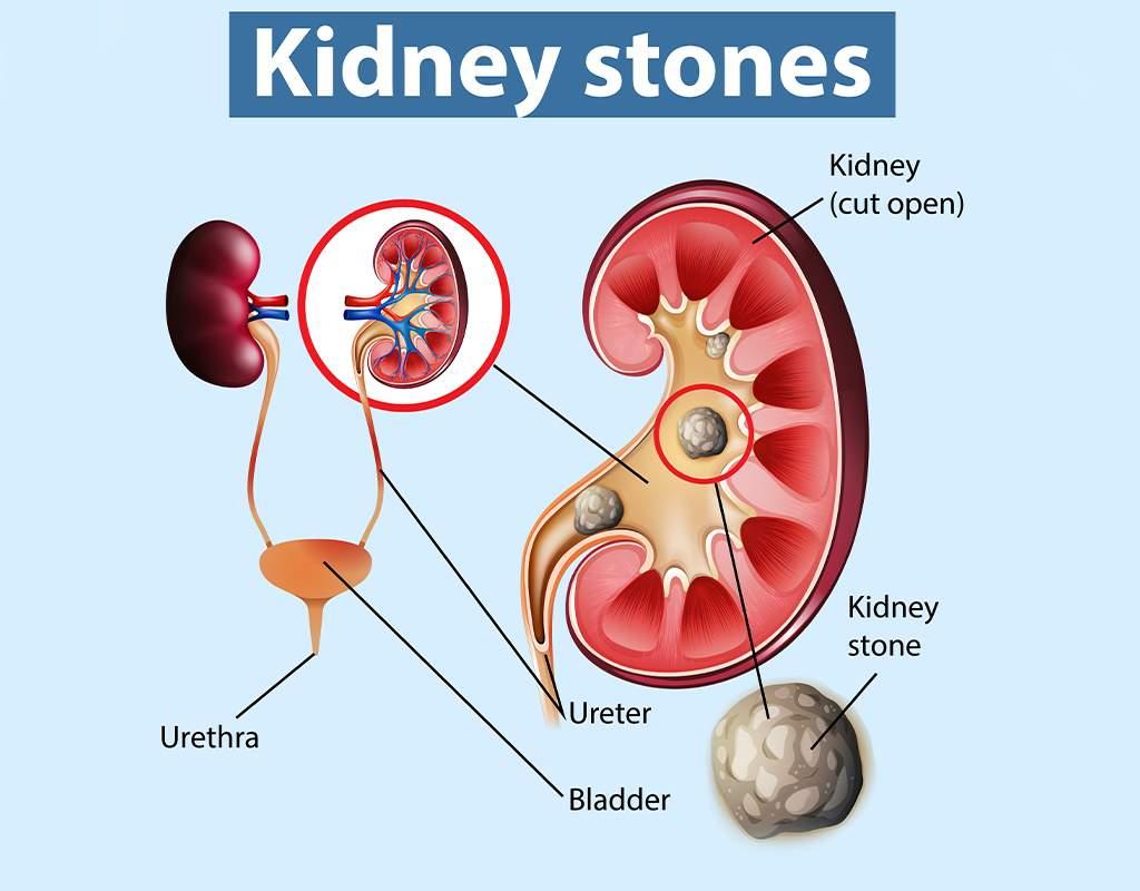 Treatment of Kidney Stones
