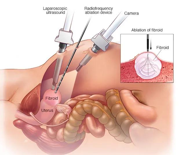 Surgical Treatment of Uterine Fibroids