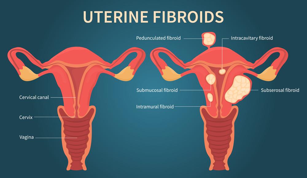 Non-Surgical Treatment of Uterine Fibroids