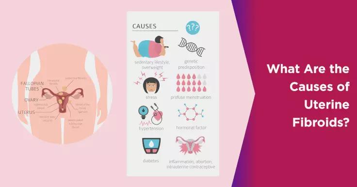 Causes of Uterine Fibroids